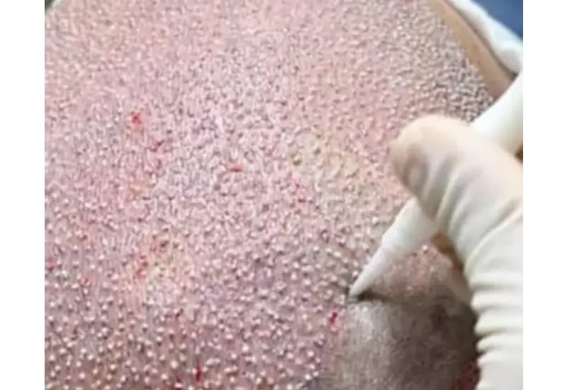 Hair Transplant In Turkey