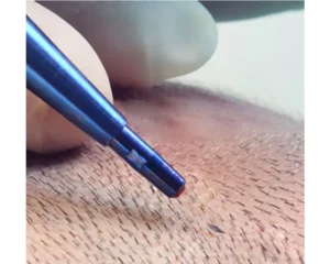 Hair Transplant In Turkey